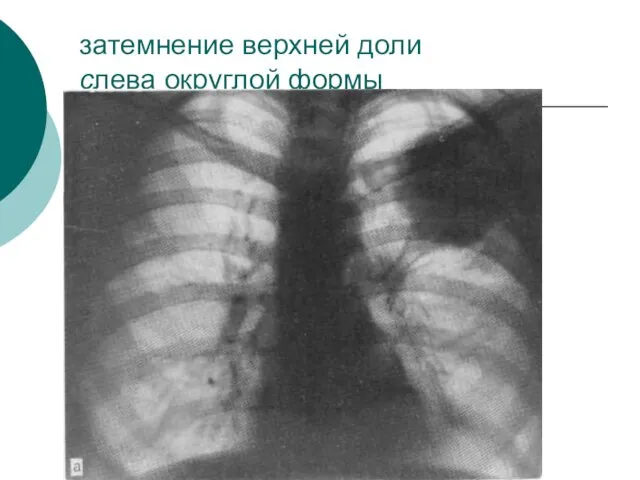 затемнение верхней доли слева округлой формы