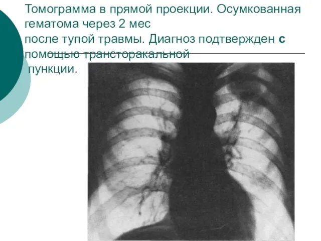 Томограмма в прямой проекции. Осумкованная гематома через 2 мес после