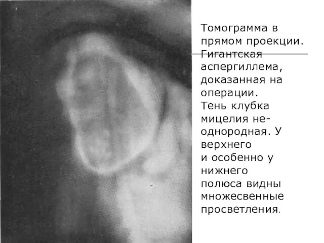 Томограмма в прямом проекции. Гигантская аспергиллема, доказанная на операции. Тень