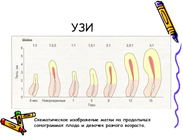 УЗИ Схематическое изображение матки на продольных сонограммах плода и девочек разного возраста.