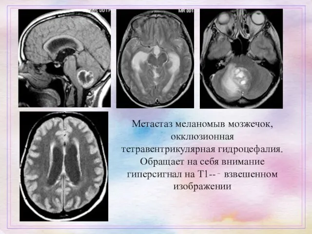 Метастаз меланомыв мозжечок, окклюзионная тетравентрикулярная гидроцефалия. Обращает на себя внимание гиперсигнал на T1--‐ взвешенном изображении