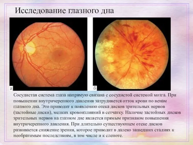 Исследование глазного дна Сосудистая система глаза напрямую связана с сосудистой системой мозга. При