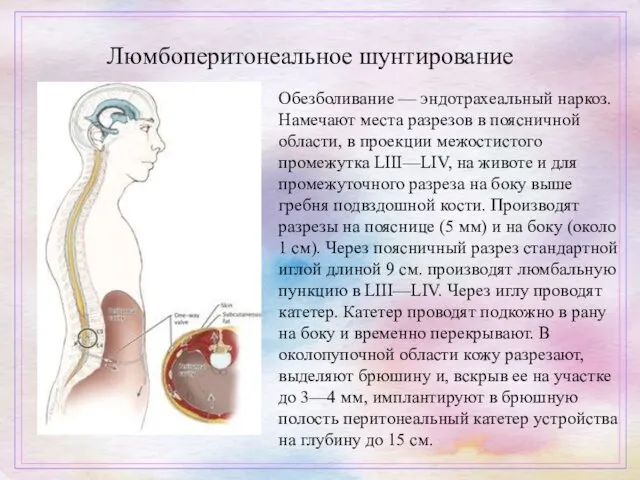 Люмбоперитонеальное шунтирование Обезболивание — эндотрахеальный наркоз. Намечают места разрезов в