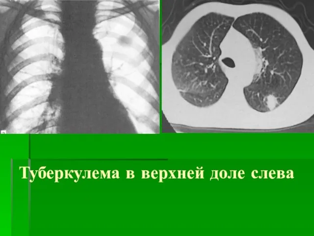 Туберкулема в верхней доле слева