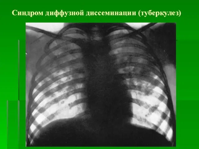 Синдром диффузной диссеминации (туберкулез)