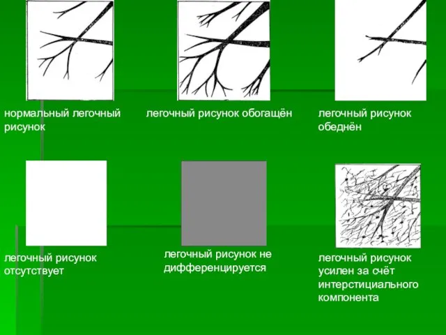 нормальный легочный рисунок легочный рисунок обогащён легочный рисунок обеднён легочный