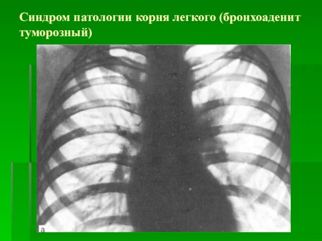 Синдром патологии корня легкого (бронхоаденит туморозный)