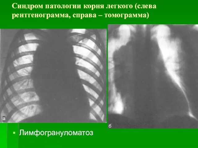 Синдром патологии корня легкого (слева рентгенограмма, справа – томограмма) Лимфогрануломатоз