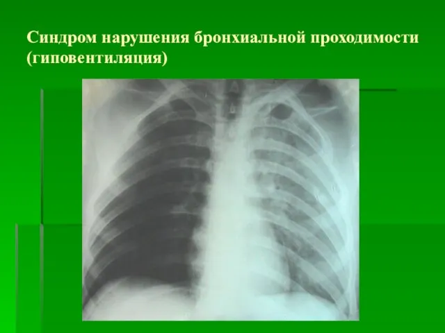 Синдром нарушения бронхиальной проходимости (гиповентиляция)