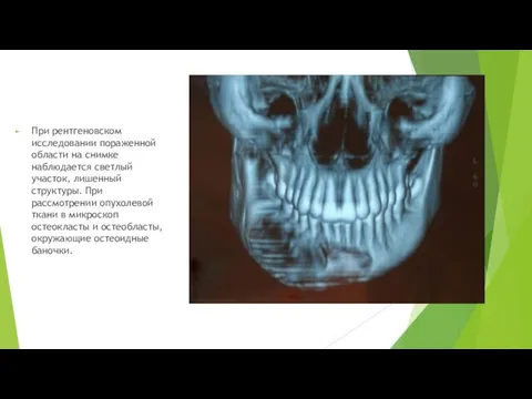 При рентгеновском исследовании пораженной области на снимке наблюдается светлый участок,