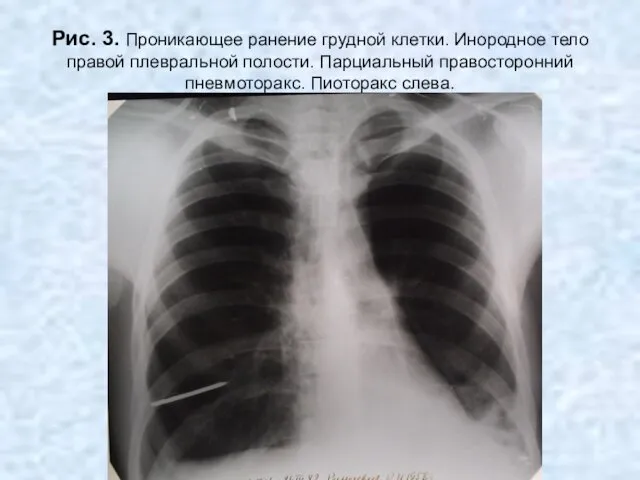 Н.С. Воротынцева, С.С. Гольев Рентгенопульмонология Рис. 3. Проникающее ранение грудной
