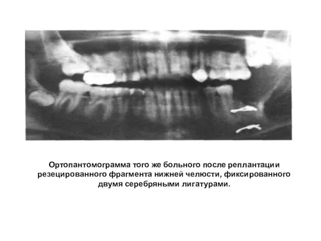 Ортопантомограмма того же больного после реплантации резецированного фрагмента нижней челюсти, фиксированного двумя серебряными лигатурами.