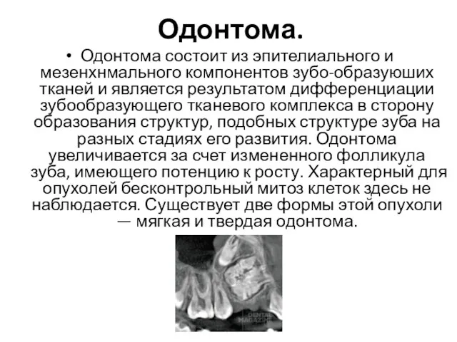 Одонтома. Одонтома состоит из эпителиального и мезенхнмального компонентов зубо-образуюших тканей