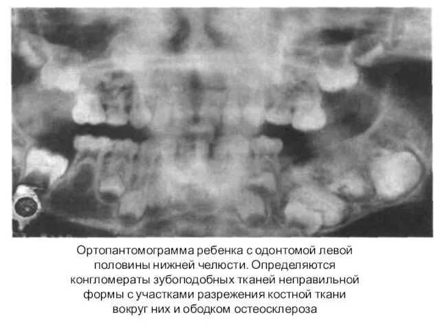 Ортопантомограмма ребенка с одонтомой левой половины нижней челюсти. Опре­деляются конгломераты