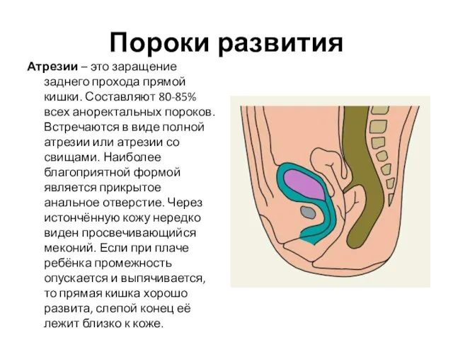 Пороки развития Атрезии – это заращение заднего прохода прямой кишки.