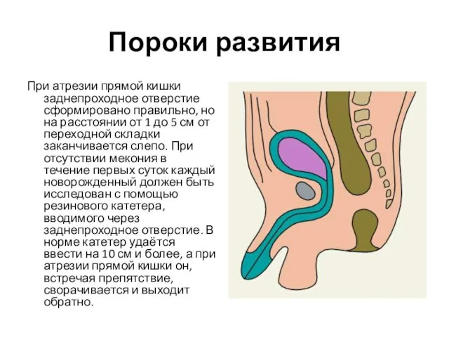 Пороки развития При атрезии прямой кишки заднепроходное отверстие сформировано правильно,