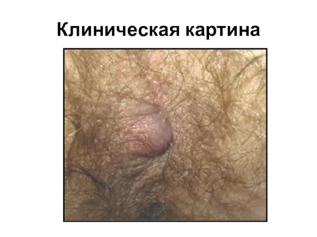 Клиническая картина