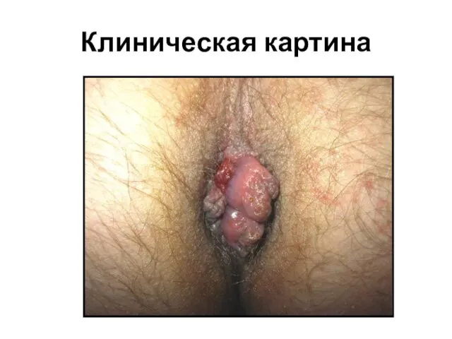 Клиническая картина