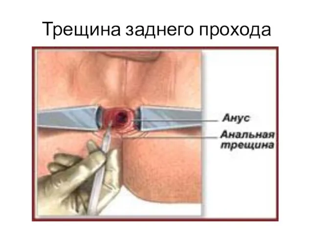 Трещина заднего прохода