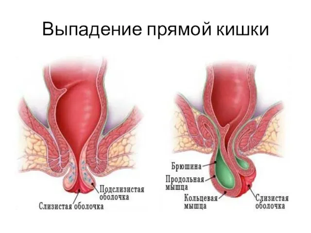 Выпадение прямой кишки