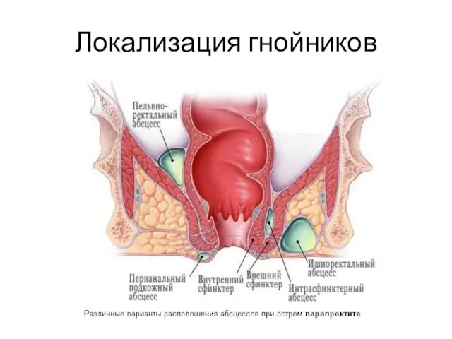 Локализация гнойников