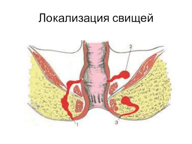 Локализация свищей