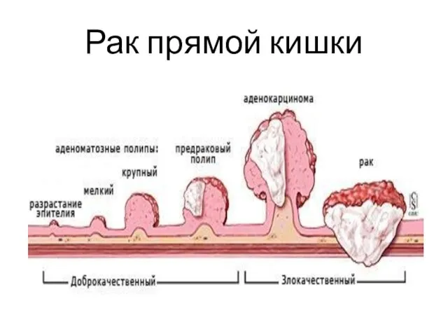 Рак прямой кишки