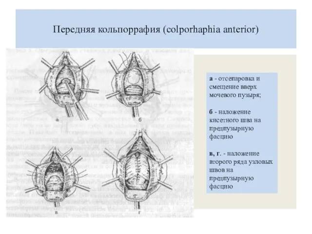 Передняя кольпоррафия (colporhaphia anterior) а - отсепаровка и смещение вверх