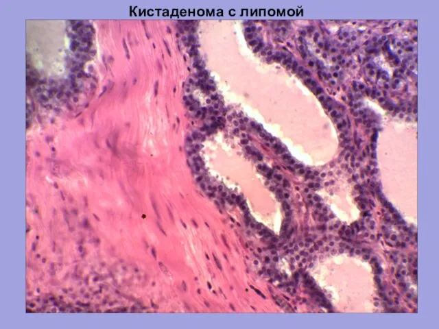 Кистаденома с липомой