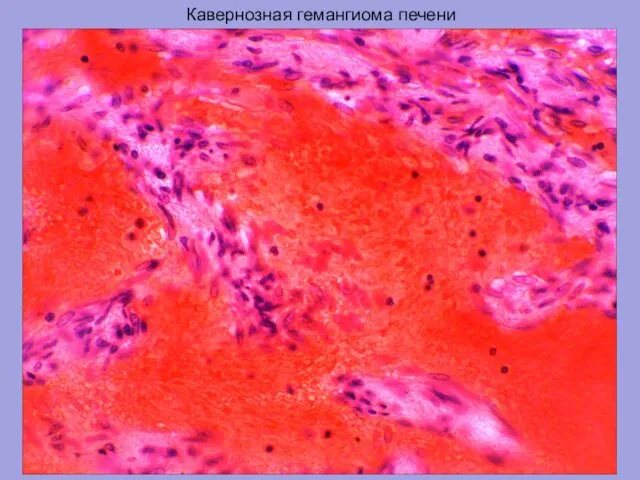 Кавернозная гемангиома печени