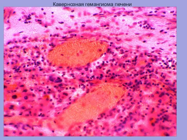 Кавернозная гемангиома печени