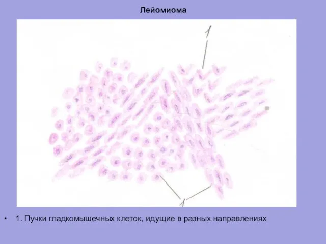 Лейомиома 1. Пучки гладкомышечных клеток, идущие в разных направлениях