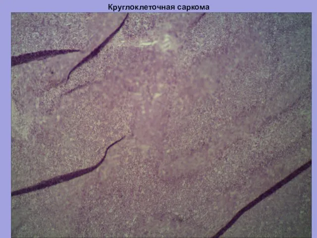 Круглоклеточная саркома