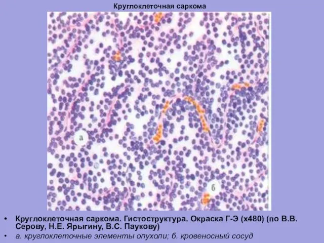 Круглоклеточная саркома Круглоклеточная саркома. Гистоструктура. Окраска Г-Э (х480) (по В.В. Серову, Н.Е. Ярыгину,