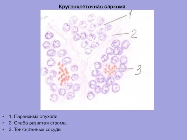 Круглоклеточная саркома 1. Паренхима опухоли. 2. Слабо развитая строма. 3. Тонкостенные сосуды