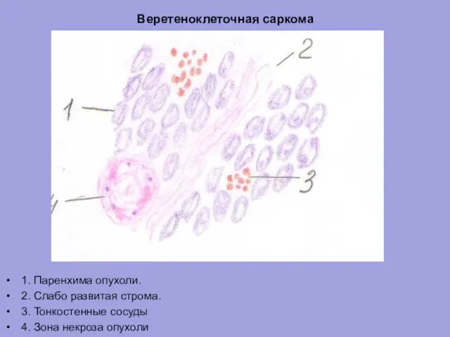 Веретеноклеточная саркома 1. Паренхима опухоли. 2. Слабо развитая строма. 3. Тонкостенные сосуды 4. Зона некроза опухоли