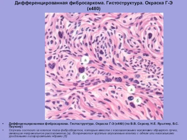 Дифференцированная фибросаркома. Гистоструктура. Окраска Г-Э (х480) Дифференцированная фибросаркома. Гистоструктура. Окраска