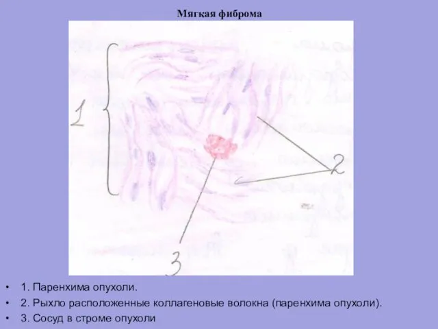 Мягкая фиброма 1. Паренхима опухоли. 2. Рыхло расположенные коллагеновые волокна