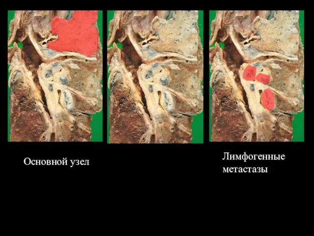 Основной узел Лимфогенные метастазы