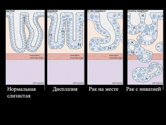 Нормальная слизистая Дисплазия Рак на месте Рак с инвазией