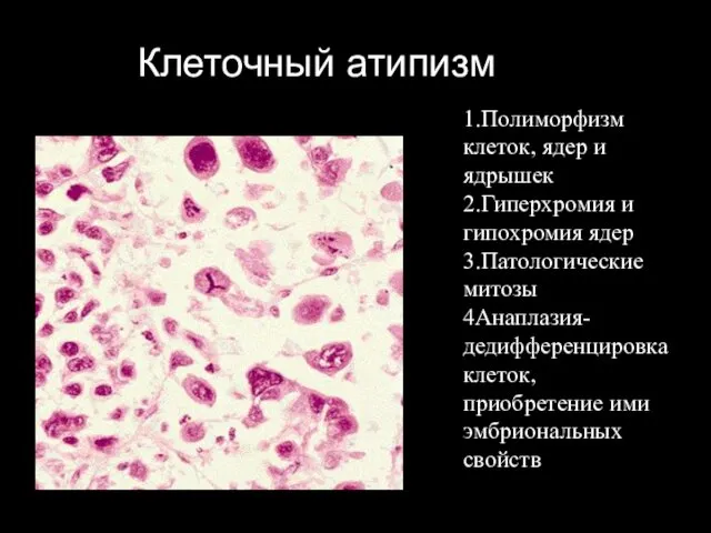 Клеточный атипизм 1.Полиморфизм клеток, ядер и ядрышек 2.Гиперхромия и гипохромия