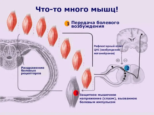 Что-то много мышц! Раздражение болевых рецепторов Защитное мышечное напряжение (спазм),