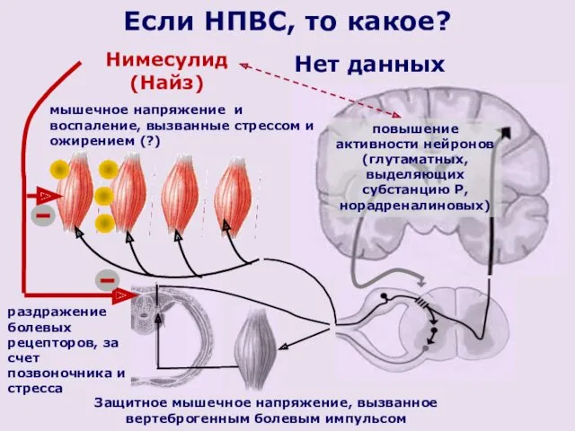 Защитное мышечное напряжение, вызванное вертеброгенным болевым импульсом повышение активности нейронов