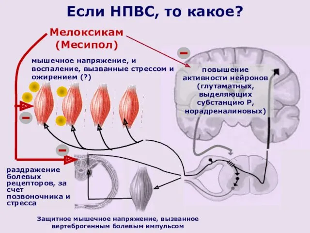 Защитное мышечное напряжение, вызванное вертеброгенным болевым импульсом повышение активности нейронов