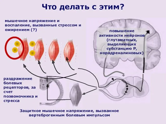 Защитное мышечное напряжение, вызванное вертеброгенным болевым импульсом повышение активности нейронов