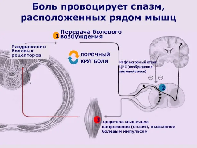 Боль провоцирует спазм, расположенных рядом мышц Раздражение болевых рецепторов Защитное