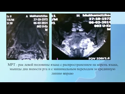 МРТ - рак левой половины языка с распространением на корень