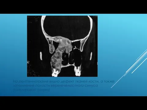 На рентгеннограме видно дефект тканей кости, а также затемнение полости верхнечелюстного синуса (гайморовой пазухи)