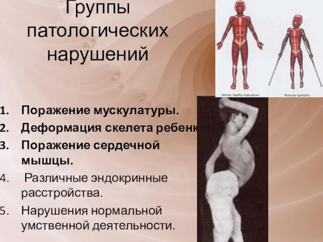 Группы патологических нарушений Поражение мускулатуры. Деформация скелета ребенка. Поражение сердечной мышцы. Различные эндокринные