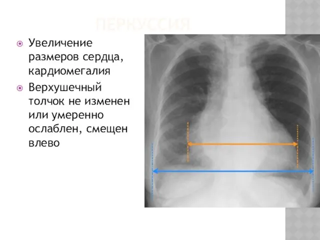 ПЕРКУССИЯ Увеличение размеров сердца, кардиомегалия Верхушечный толчок не изменен или умеренно ослаблен, смещен влево